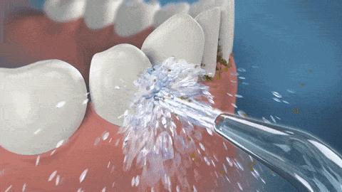 塞牙可能是你的牙在喊救命 牙缝变大背后的警报