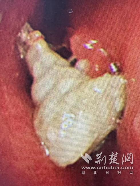 男子假牙卡喉险窒息医生取出