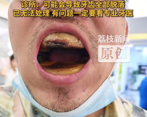 买5元树脂自行补牙致口腔变年糕 诊所回应