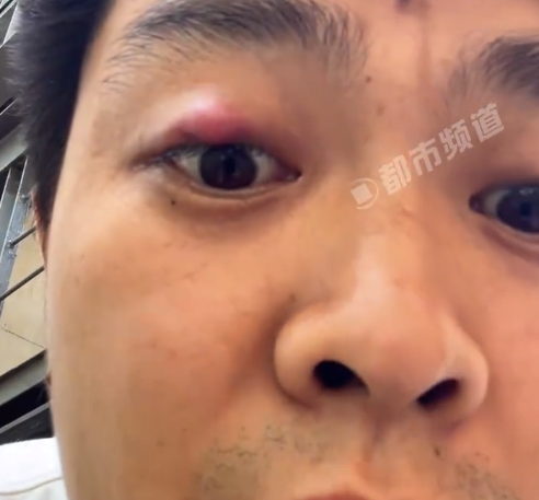 男子眼皮长花生大痘痘求问网友咋办：涂药也无用，自己慌了