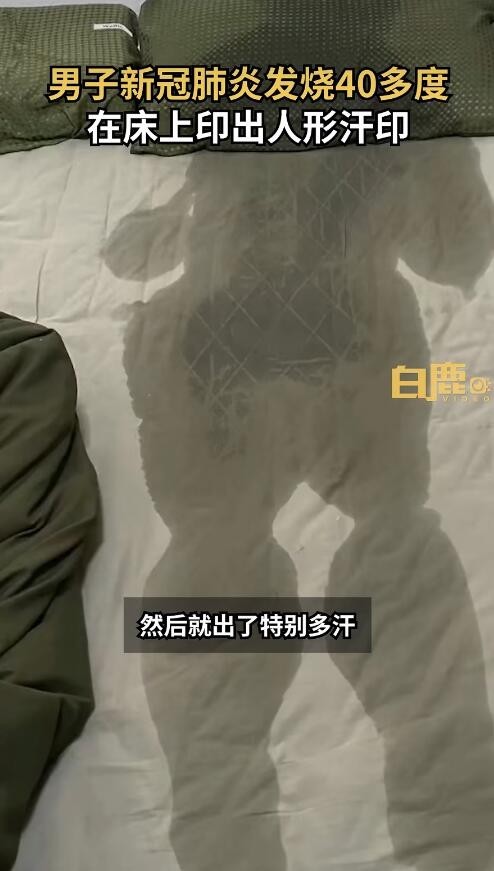 男子发烧近40度床上印出人形汗印