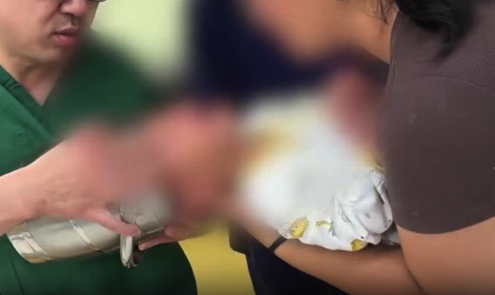 兒童頭卡在飯缸里無法取出 醫(yī)生邊安撫邊取下