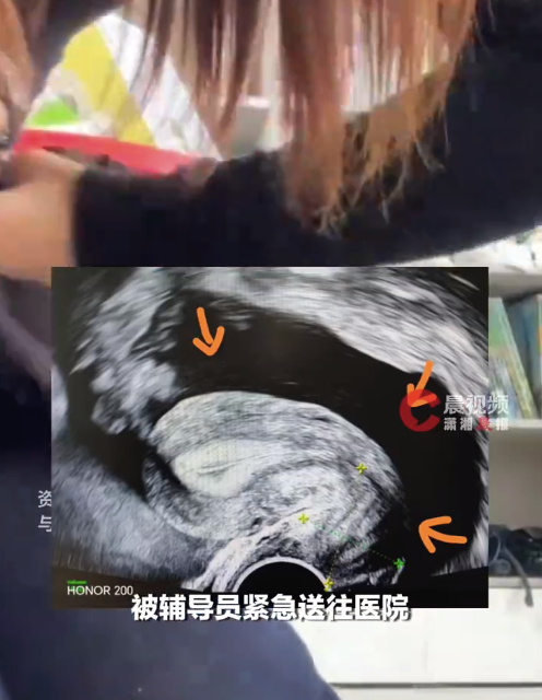 女孩洗澡搓腹后腹腔出血達上千毫升 醫(yī)生提醒