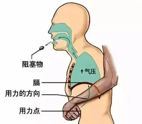 8天婴儿呛奶爸爸海姆立克急救