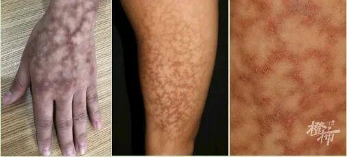 一覺睡醒長出“蟒蛇紋”、水皰！冬季警惕這類燙傷