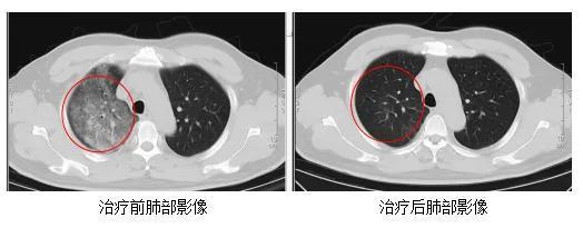 江苏确诊一例罕见传染病 Q热病例出现