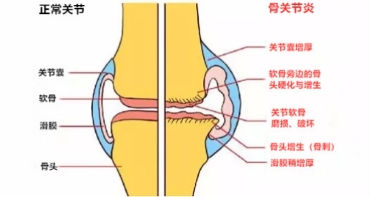 明晰西乐葆塞来昔布胶囊说明书，骨关节炎用药更安心