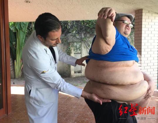 前世界最胖的人病逝 曾重达600公斤 与肥胖长期斗争后离世