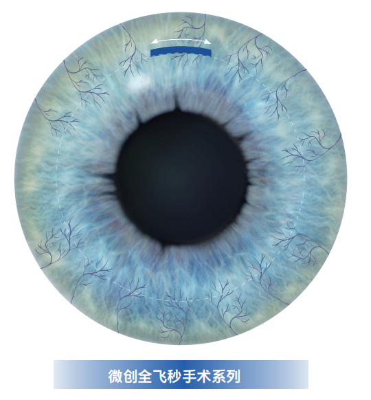 一文读懂：新一代全飞秒SMILE pro如何轻松告别近视