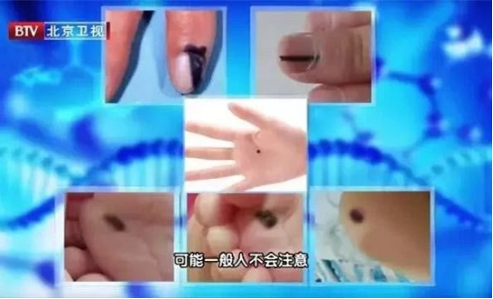 可怕！女子十指空甲发霉，还有人全甲拔除，全因这事惹病上身