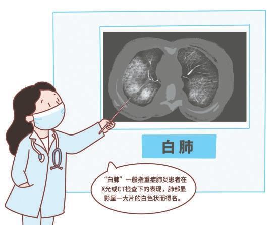 感染甲流也可能引起白肺 多见于老人、儿童、孕妇等人群