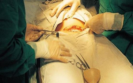 剖腹产要切多少层,全过程是怎样的(2)