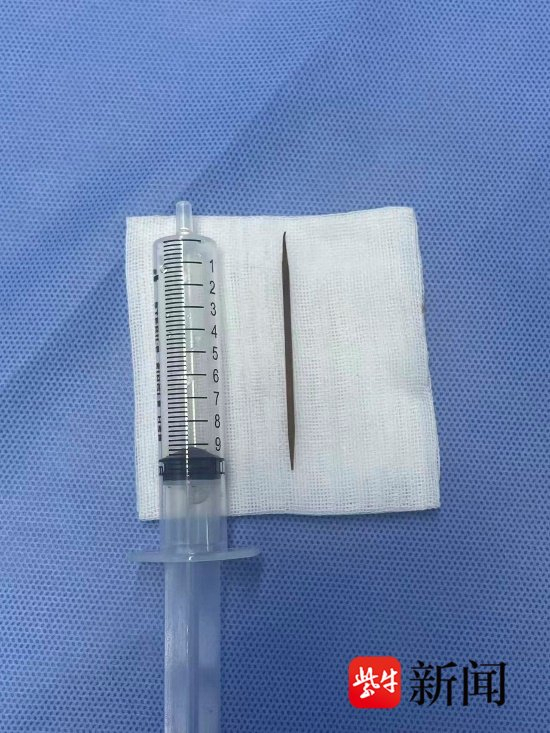 男子腹痛14天肚中取出6cm牙簽 險些腸穿孔
