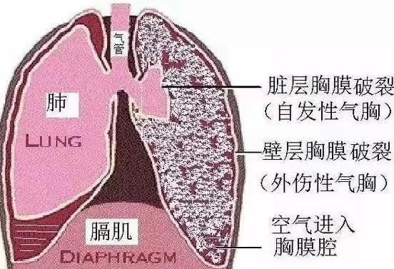 什么是爆肺 氣胸引發(fā)關(guān)注