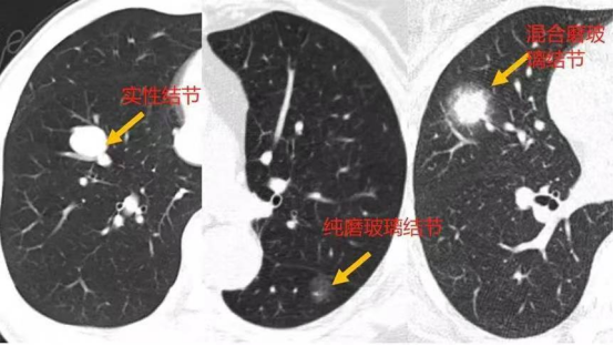 中国肺结节人群超1.3亿且越来越年轻，如何早期发现恶性肿瘤？ 警惕青年群体