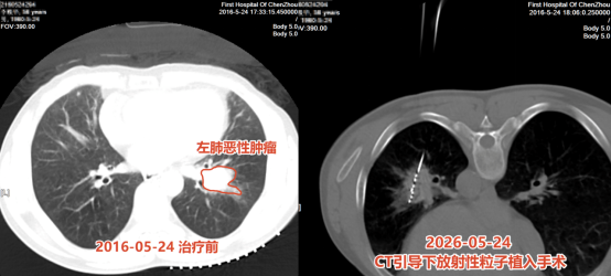 65岁爷爷患肺癌晚期存活10年