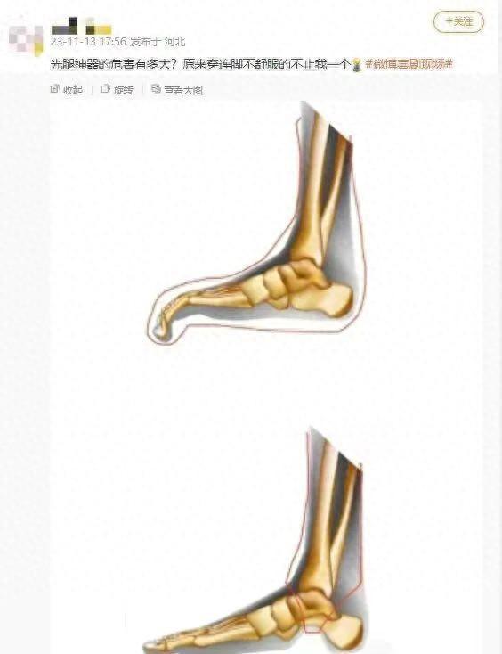 爱穿光腿神器，23岁女孩勒出甲沟炎