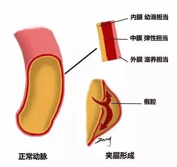 厦门1个月内连发34例主动脉夹层 警惕 “血管炸弹”！