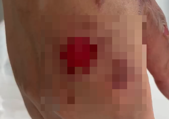 女子在饭店用餐时被烧伤 餐厅：顾客为拍视频要求多加酒精