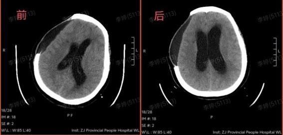 高溫曬背2小時67歲阿姨開顱保命