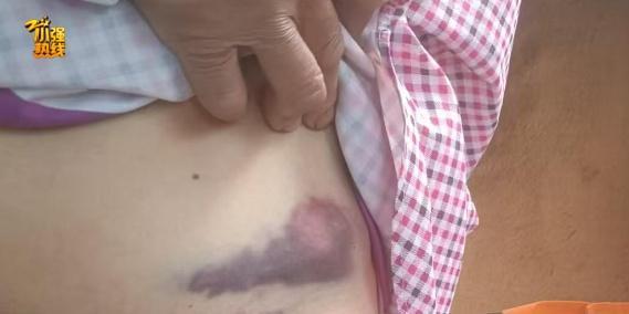 女子上班路上被大狼狗扑咬得血肉模糊 双方就赔偿金额产生分歧