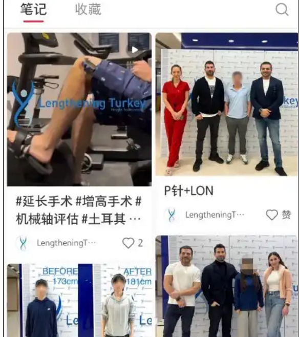 “斷骨增高術”國內死灰複燃 專家警告風險依然巨大