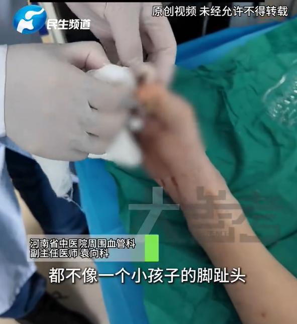 20岁姑娘一天4杯全塘奶茶咖啡险截肢 糖尿病足警示