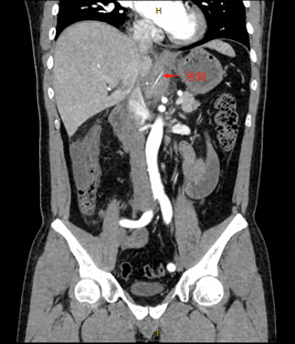 男子腹痛一个月CT拍出鱼刺插进腹腔