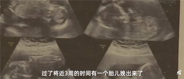 山东一孕妇身怀四胞胎生产不同天 已有两个出生