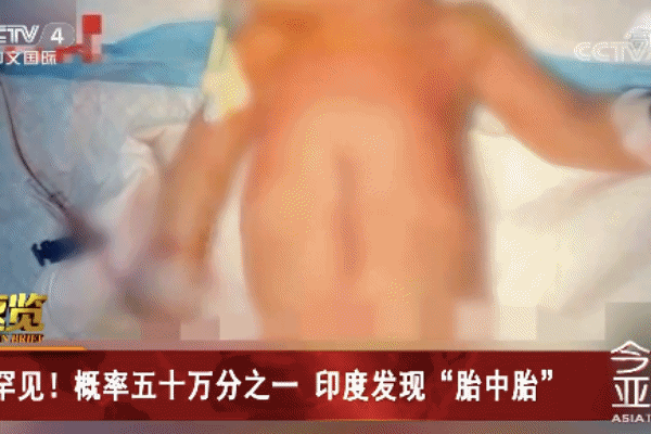 3周大女婴肚子里取出8个寄生胎：发病率五十万分之一