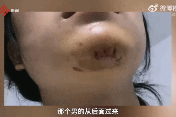 女子溜冰被人推倒下巴缝十多针 网友：看着都疼