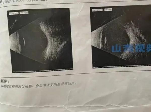 1岁婴儿被查出近视600度 原因竟在父母身上