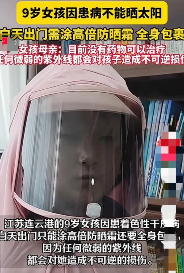 9歲女孩患罕見病不能曬太陽 與紫外線賽跑