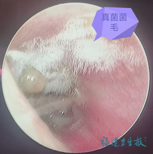 女子耳朵里長“腳氣” 醫(yī)生提醒：平時盡量少掏耳朵