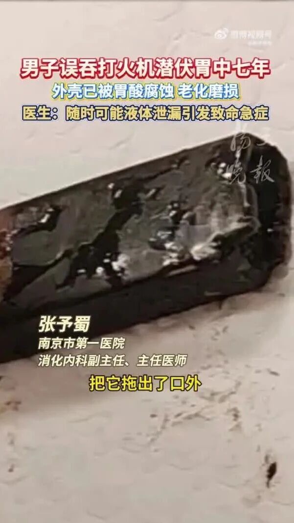 打火机在体内待7年险致胃穿孔