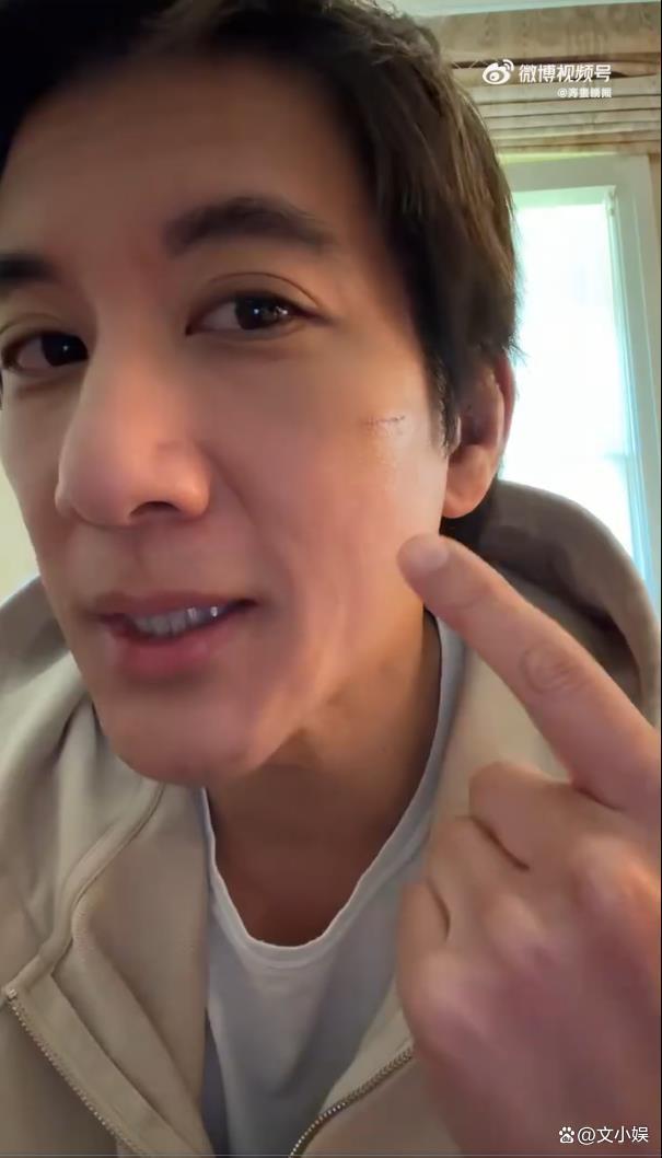 王力宏晒伤口恢复情况 预计明日拆线