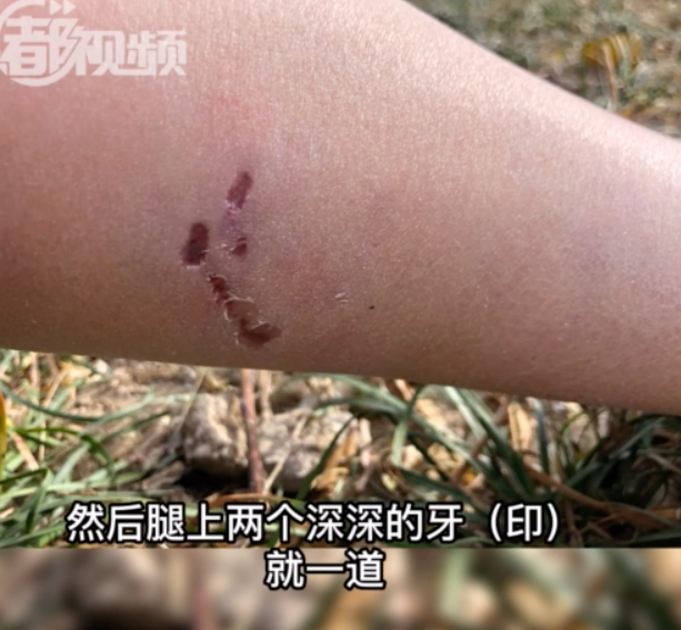 遛狗不栓绳路人腿上被咬出两道大狗牙印 犬主人的电话却一直无法接通！