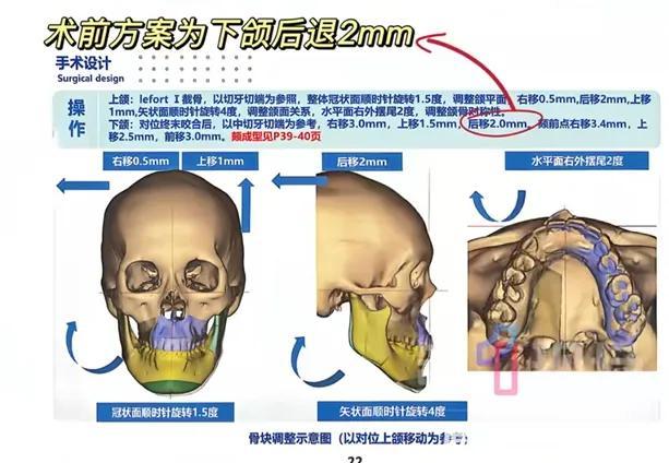 女孩正颌手术被做反医院想再次调解 医患纠纷再起波澜
