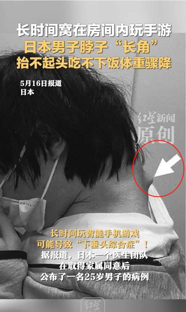 日本男子沉迷手游脖子長角 抬不起頭