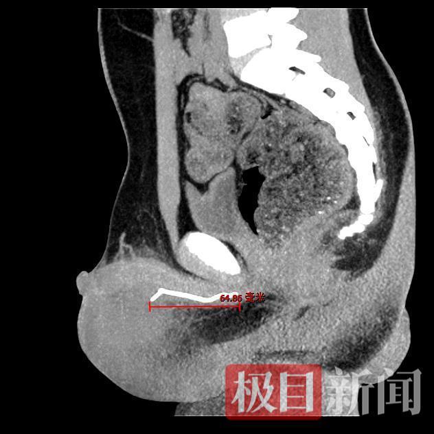 男孩因好奇將鐵絲塞進尿道憋80多天 醫(yī)生微創(chuàng)手術(shù)成功取出7厘米鐵絲