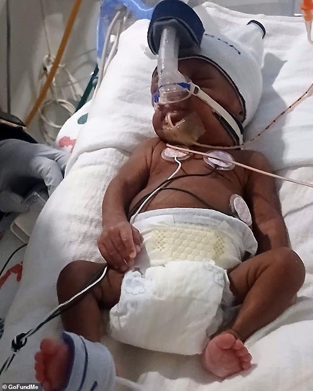 美国女子脑死亡被迫生下孩子 婴儿重病难出院