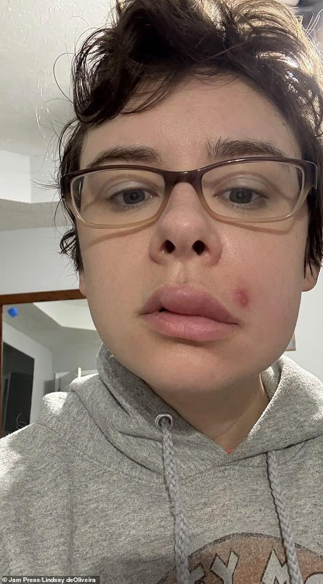 面部三角区的附近痘痘千万别乱挤 女子挤痘后半脸面瘫