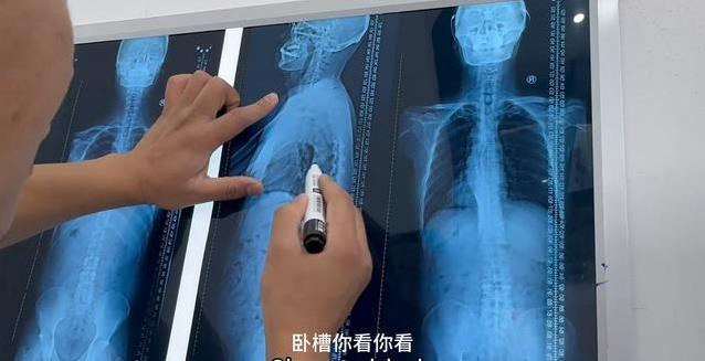60岁大爷腰痛求正骨，医生看片吓一跳，脖子竟藏大问题