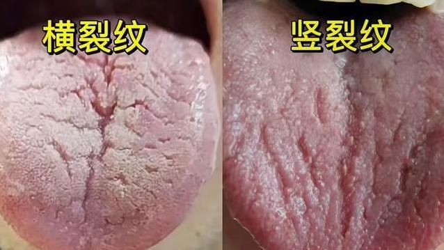 舌头裂纹暴露健康秘密，横纹顺气竖纹滋阴，3招让你舌头变光滑