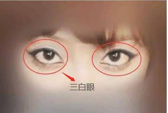 北京好年华五维锚定双眼皮：三白眼做双眼皮有没有影响？