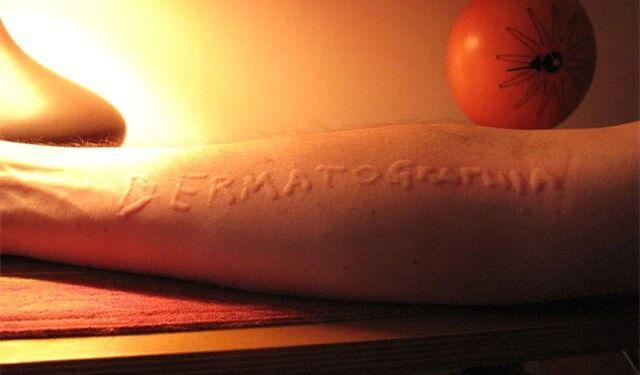  轻轻一抓，皮肤就出现了红印子，是得病了吗？需要治疗吗？