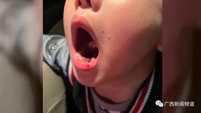 6岁男童被钢琴老师扇掉一颗牙 反让家长给自己道歉