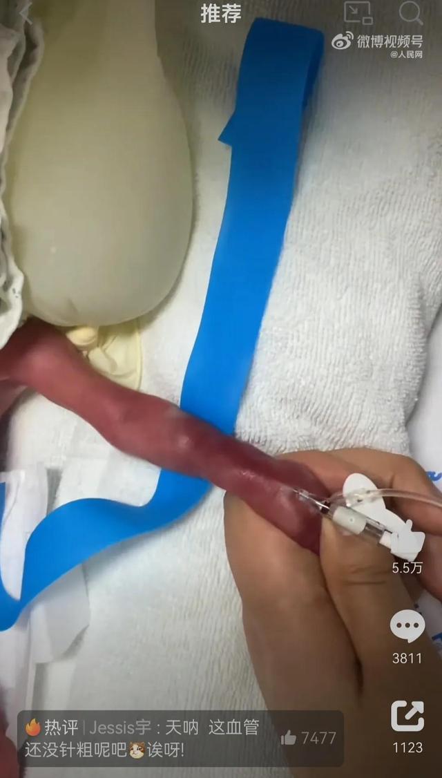 护士给0.9kg早产儿扎针：婴儿手臂只有护士手指粗，浑身紫红