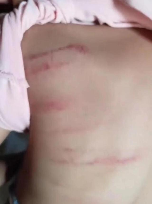 6岁女孩疑遭老师多次抽打背部 老师：妹妹不争气，为让妹妹学好才这样