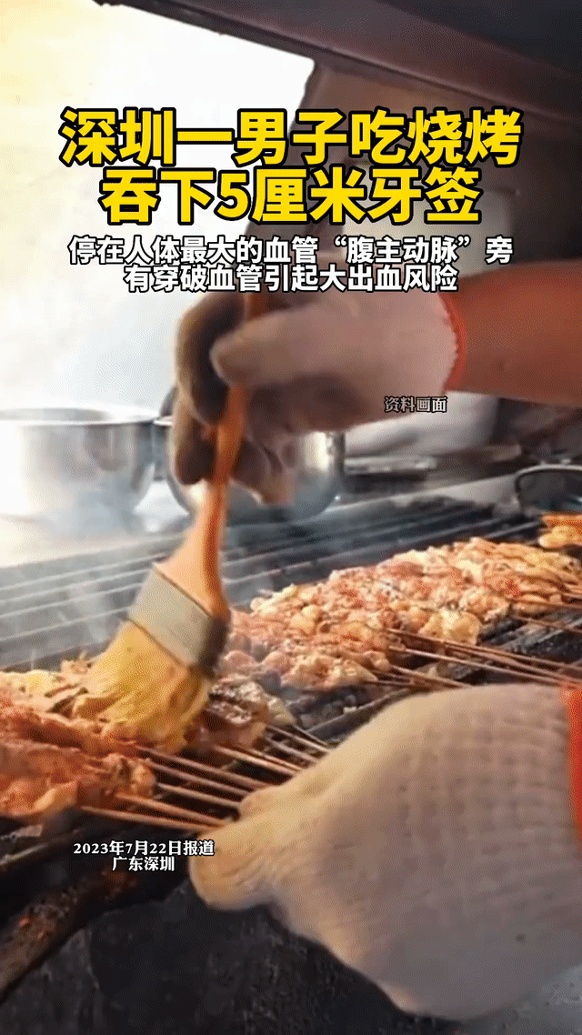 危险！深圳一男子吃烧烤吞下5厘米牙签，医生：再晚一点就没命了